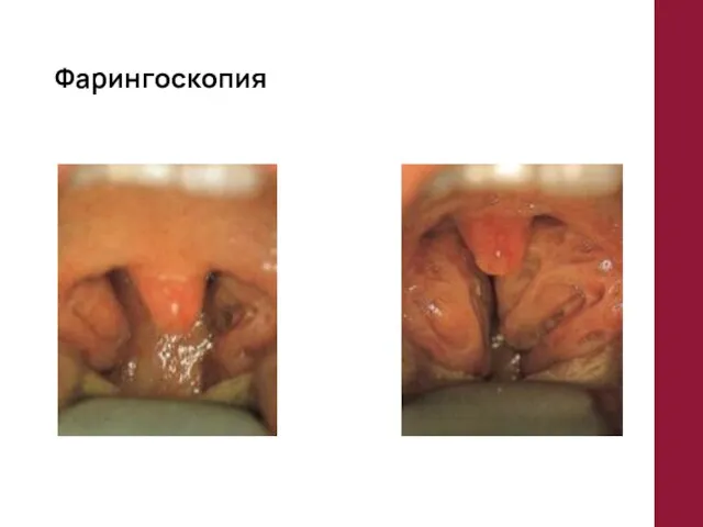 Фарингоскопия