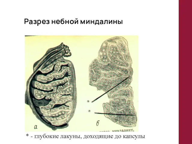 Разрез небной миндалины * - глубокие лакуны, доходящие до капсулы