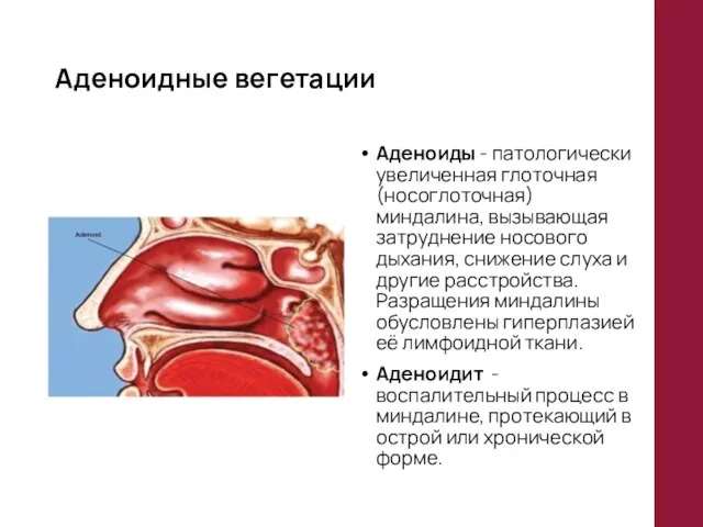 Аденоидные вегетации Аденоиды - патологически увеличенная глоточная (носоглоточная) миндалина, вызывающая затруднение