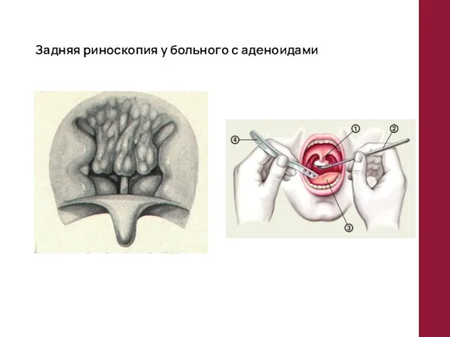 Задняя риноскопия у больного с аденоидами