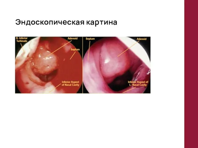 Эндоскопическая картина