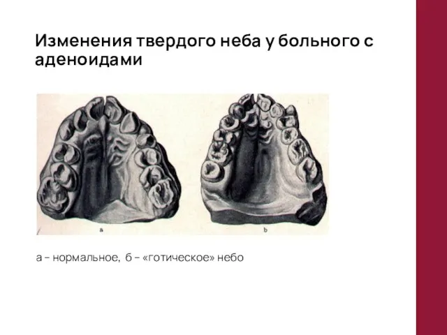 Изменения твердого неба у больного с аденоидами а – нормальное, б – «готическое» небо