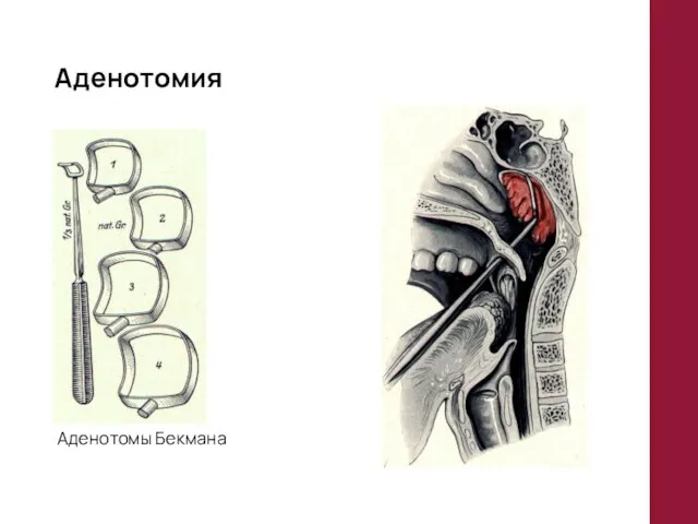 Аденотомия Аденотомы Бекмана