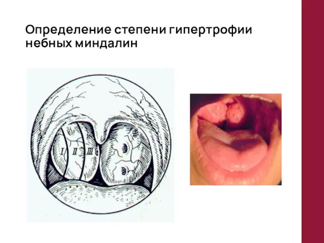 Определение степени гипертрофии небных миндалин