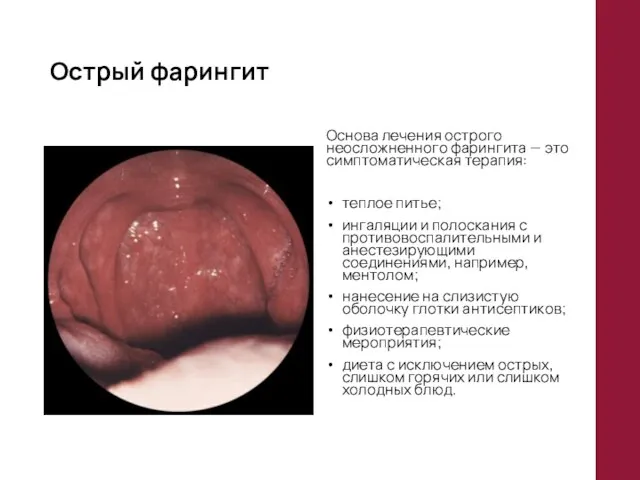 Острый фарингит Основа лечения острого неосложненного фарингита — это симптоматическая терапия: