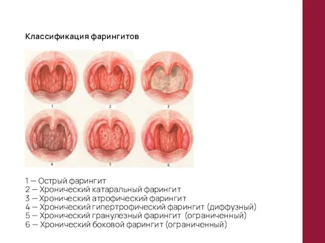 Классификация фарингитов 1 — Острый фарингит 2 — Хронический катаральный фарингит