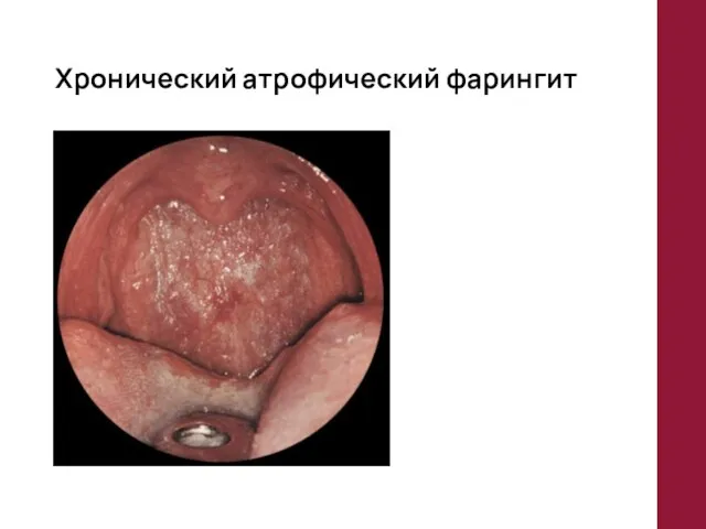 Хронический атрофический фарингит