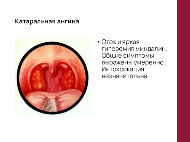 Катаральная ангина Отек и яркая гиперемия миндалин. Общие симптомы выражены умеренно. Интоксикация незначительна