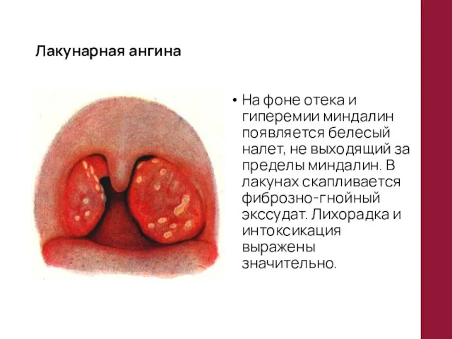 Лакунарная ангина На фоне отека и гиперемии миндалин появляется белесый налет,