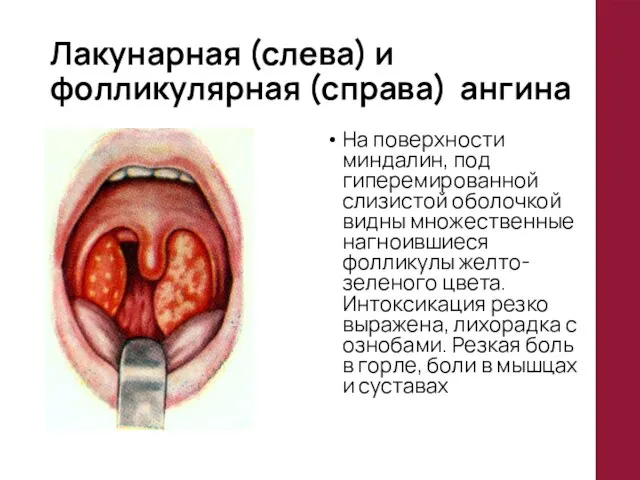 Лакунарная (слева) и фолликулярная (справа) ангина На поверхности миндалин, под гиперемированной