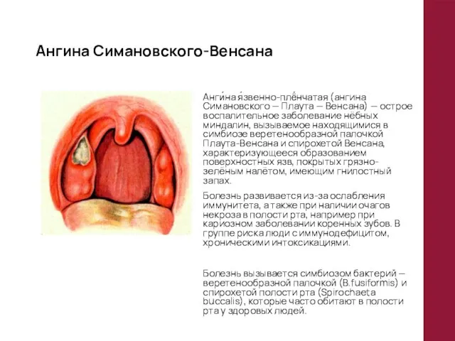 Ангина Симановского-Венсана Анги́на я́звенно-плё́нчатая (ангина Симановского — Плаута — Венсана) —