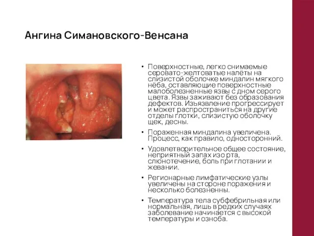 Ангина Симановского-Венсана Поверхностные, легко снимаемые серовато-желтоватые налёты на слизистой оболочке миндалин