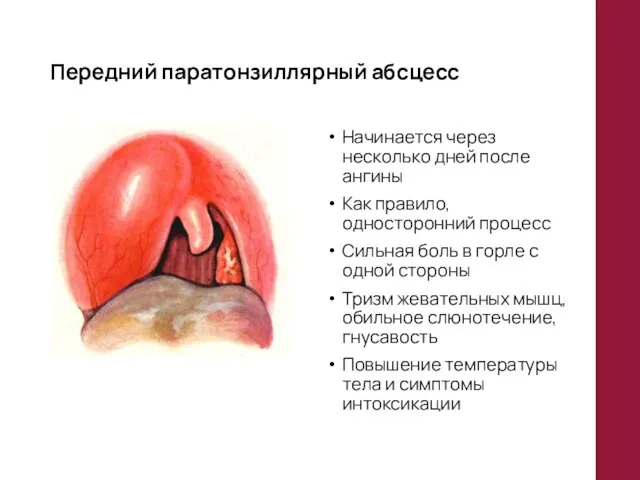 Передний паратонзиллярный абсцесс Начинается через несколько дней после ангины Как правило,