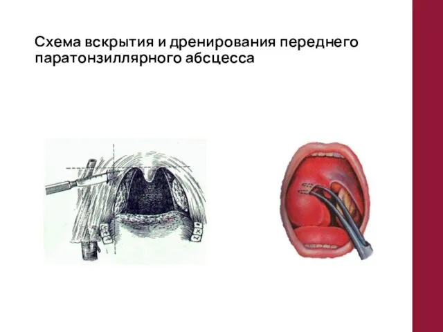 Схема вскрытия и дренирования переднего паратонзиллярного абсцесса