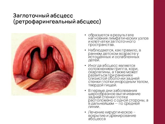 Заглоточный абсцесс (ретрофарингеальный абсцесс) образуется в результате нагноения лимфатических узлов и