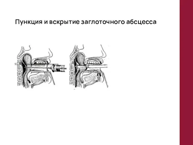 Пункция и вскрытие заглоточного абсцесса