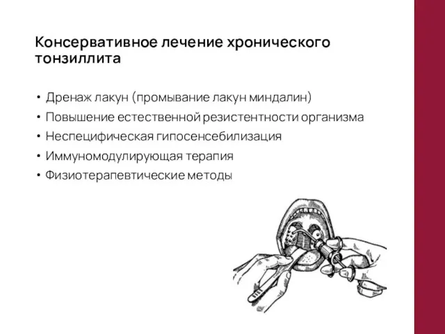 Консервативное лечение хронического тонзиллита Дренаж лакун (промывание лакун миндалин) Повышение естественной