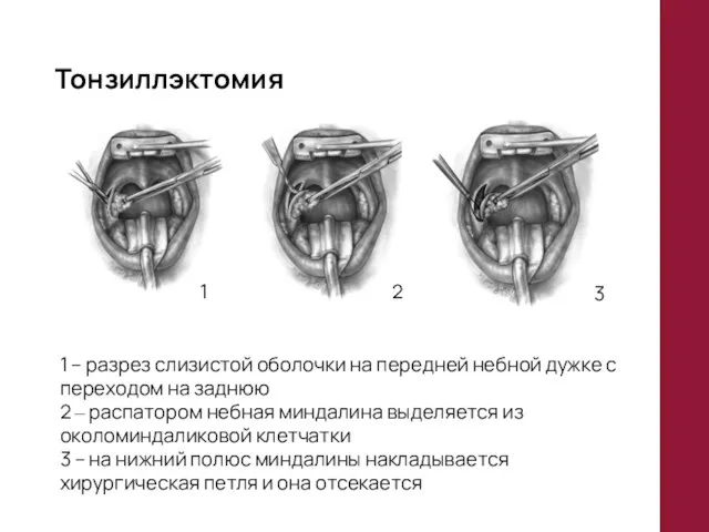 Тонзиллэктомия 1 2 3 1 – разрез слизистой оболочки на передней
