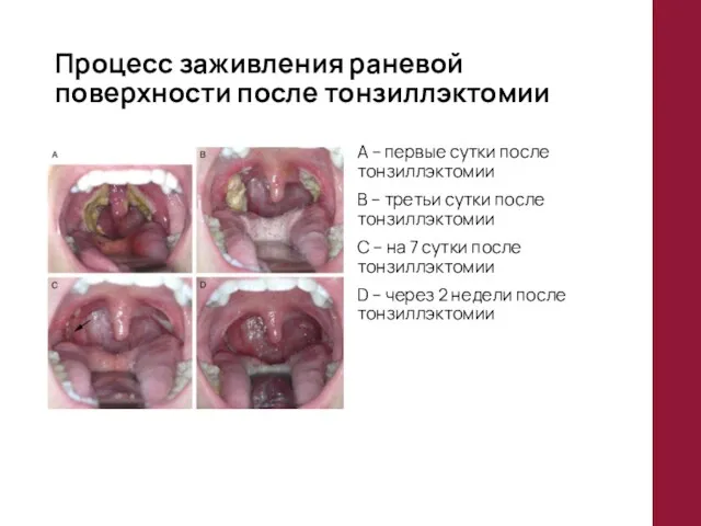 Процесс заживления раневой поверхности после тонзиллэктомии A – первые сутки после