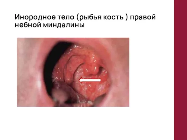 Инородное тело (рыбья кость ) правой небной миндалины