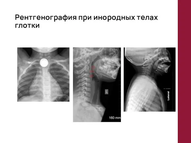 Рентгенография при инородных телах глотки