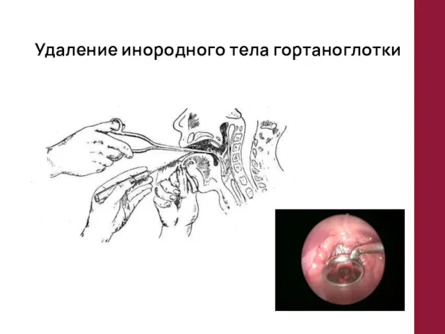 Удаление инородного тела гортаноглотки