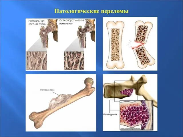 Патологические переломы