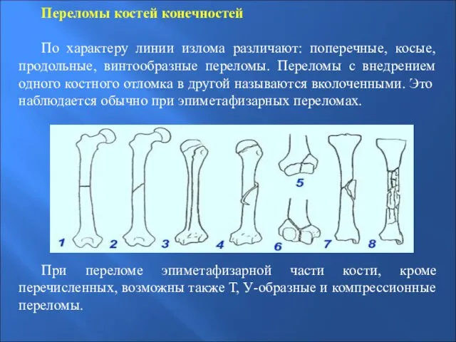 Переломы костей конечностей По характеру линии излома различают: поперечные, косые, продольные,