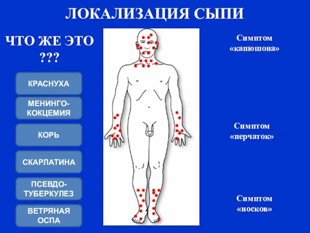 ЛОКАЛИЗАЦИЯ СЫПИ Симптом «перчаток» Симптом «носков» Симптом «капюшона» ЧТО ЖЕ ЭТО