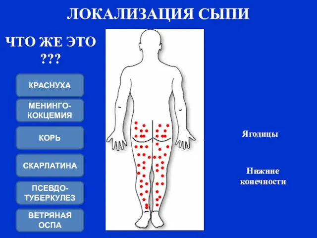 ЛОКАЛИЗАЦИЯ СЫПИ Ягодицы Нижние конечности ЧТО ЖЕ ЭТО ??? СКАРЛАТИНА ПСЕВДО-ТУБЕРКУЛЕЗ КОРЬ МЕНИНГО-КОКЦЕМИЯ КРАСНУХА ВЕТРЯНАЯ ОСПА