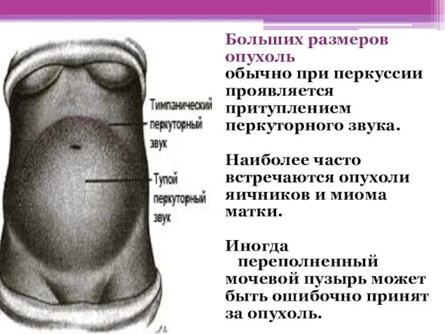 Больших размеров опухоль обычно при перкуссии проявляется притуплением перкуторного звука. Наиболее