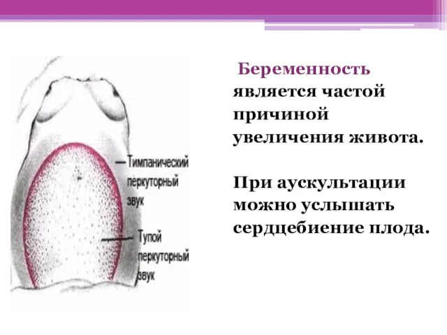 Беременность является частой причиной увеличения живота. При аускультации можно услышать сердцебиение плода.