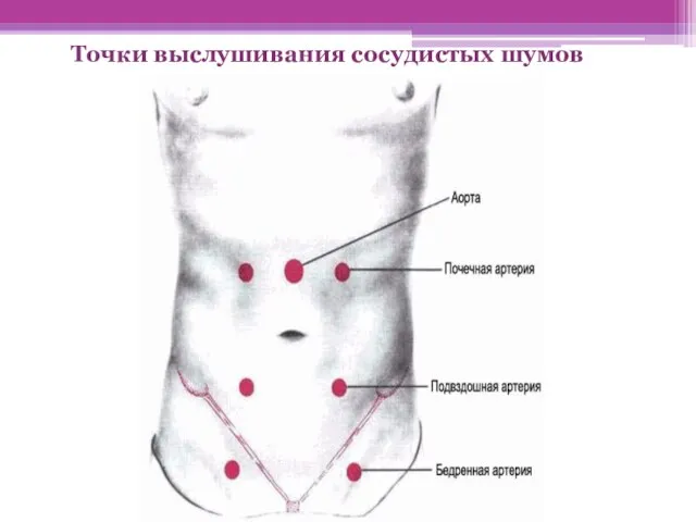 Точки выслушивания сосудистых шумов