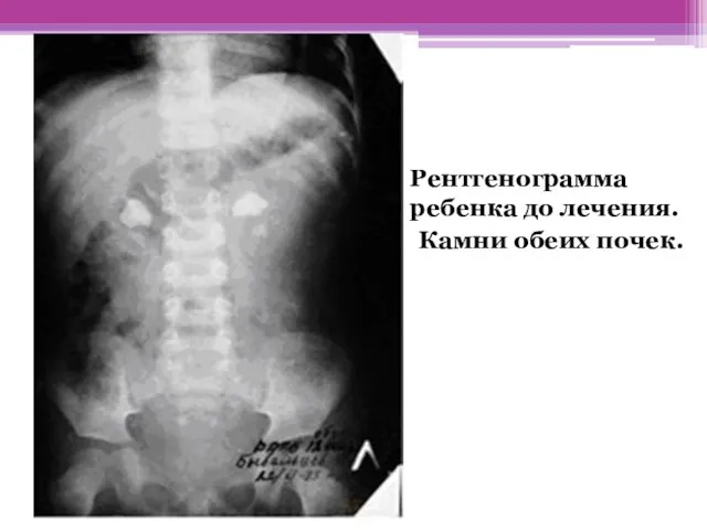 Рентгенограмма ребенка до лечения. Камни обеих почек.