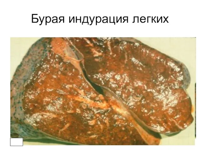 Бурая индурация легких