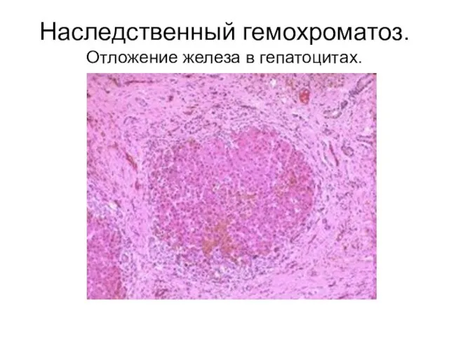 Наследственный гемохроматоз. Отложение железа в гепатоцитах.