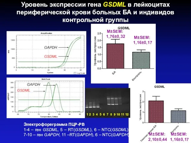 Уровень экспрессии гена GSDML в лейкоцитах периферической крови больных БА и