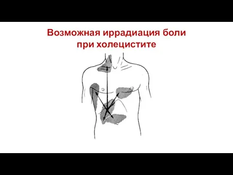 Возможная иррадиация боли при холецистите