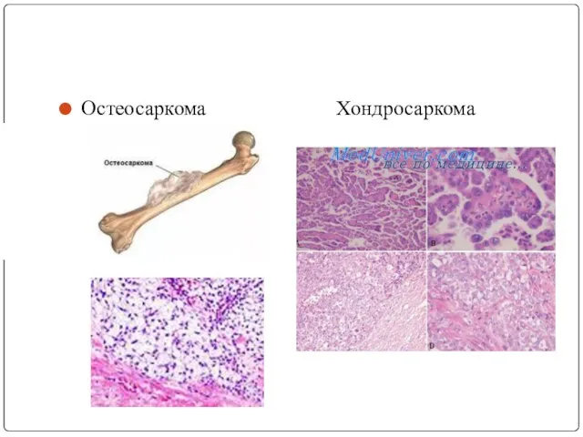 Остеосаркома Хондросаркома