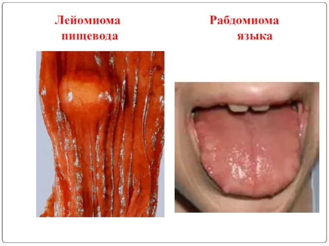 Лейомиома Рабдомиома пищевода языка