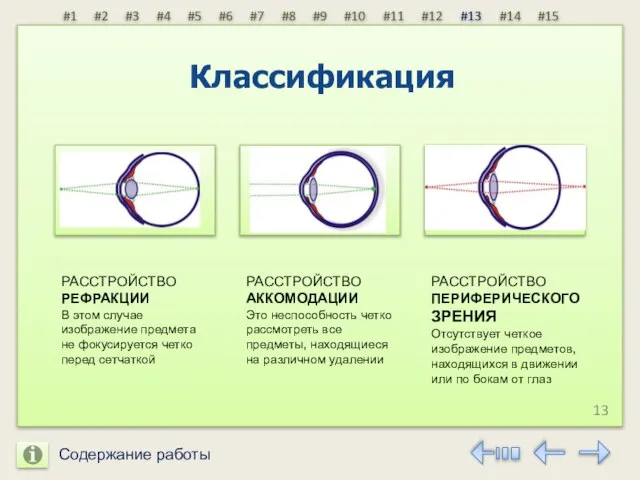 Содержание работы 13 #15 РАССТРОЙСТВО РЕФРАКЦИИ В этом случае изображение предмета