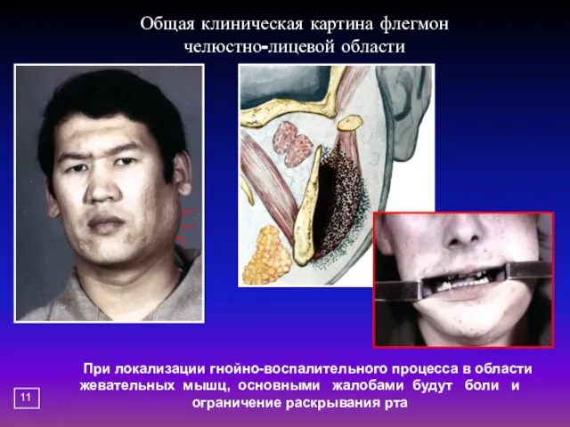 Общая клиническая картина флегмон челюстно-лицевой области При локализации гнойно-воспалительного процесса в