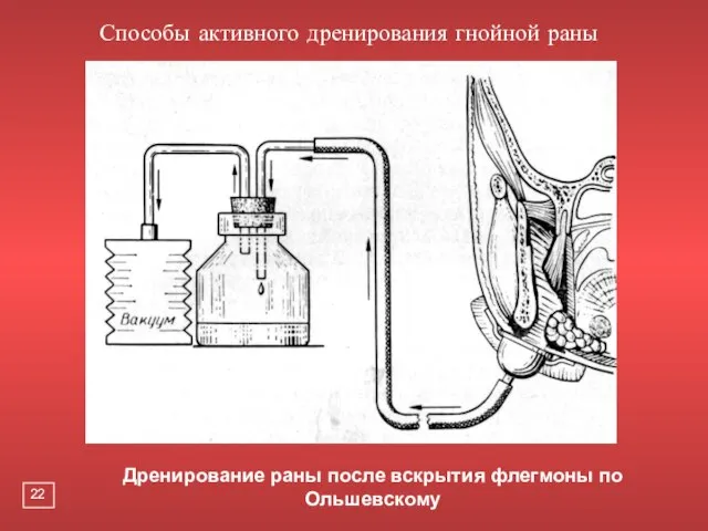 Дренирование раны после вскрытия флегмоны по Ольшевскому Способы активного дренирования гнойной раны 22