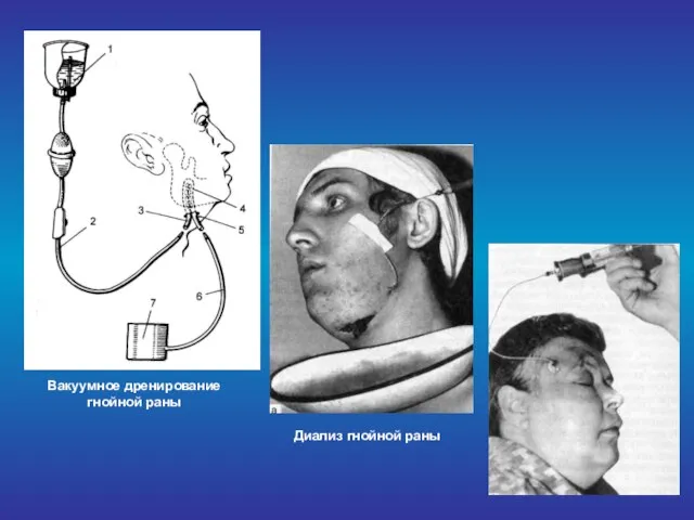 Вакуумное дренирование гнойной раны Диализ гнойной раны