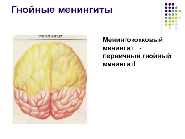 Гнойные менингиты Менингококковый менингит - первичный гнойный менингит!