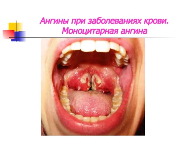 Ангины при заболеваниях крови. Моноцитарная ангина