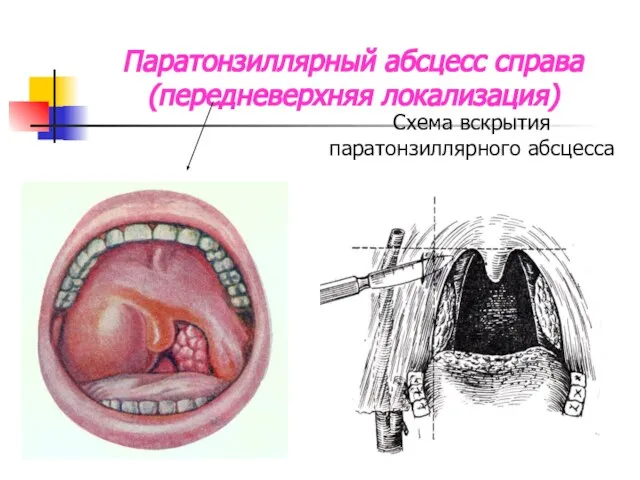 Паратонзиллярный абсцесс справа (передневерхняя локализация)