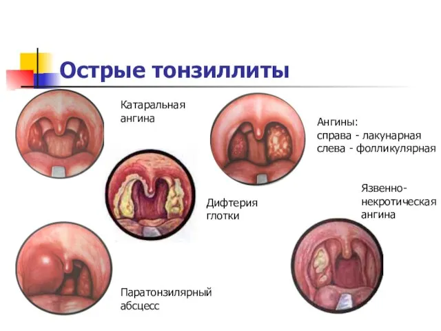 Острые тонзиллиты Катаральная ангина Паратонзилярный абсцесс Ангины: справа - лакунарная слева