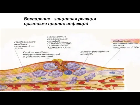 Воспаление – защитная реакция организма против инфекций