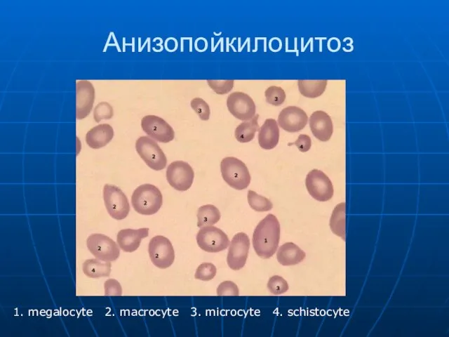 Анизопойкилоцитоз 1. megalocyte 2. macrocyte 3. microcyte 4. schistocyte